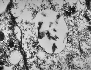 M, | cerebral cortex - malaric pigment M, | cerebral cortex - malaric pigment